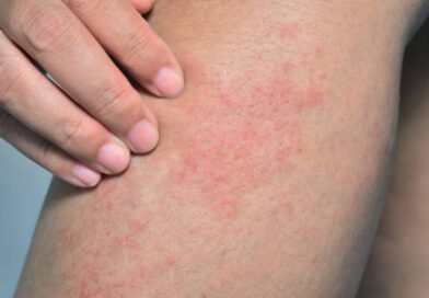 Campinas registra morte por chikungunya